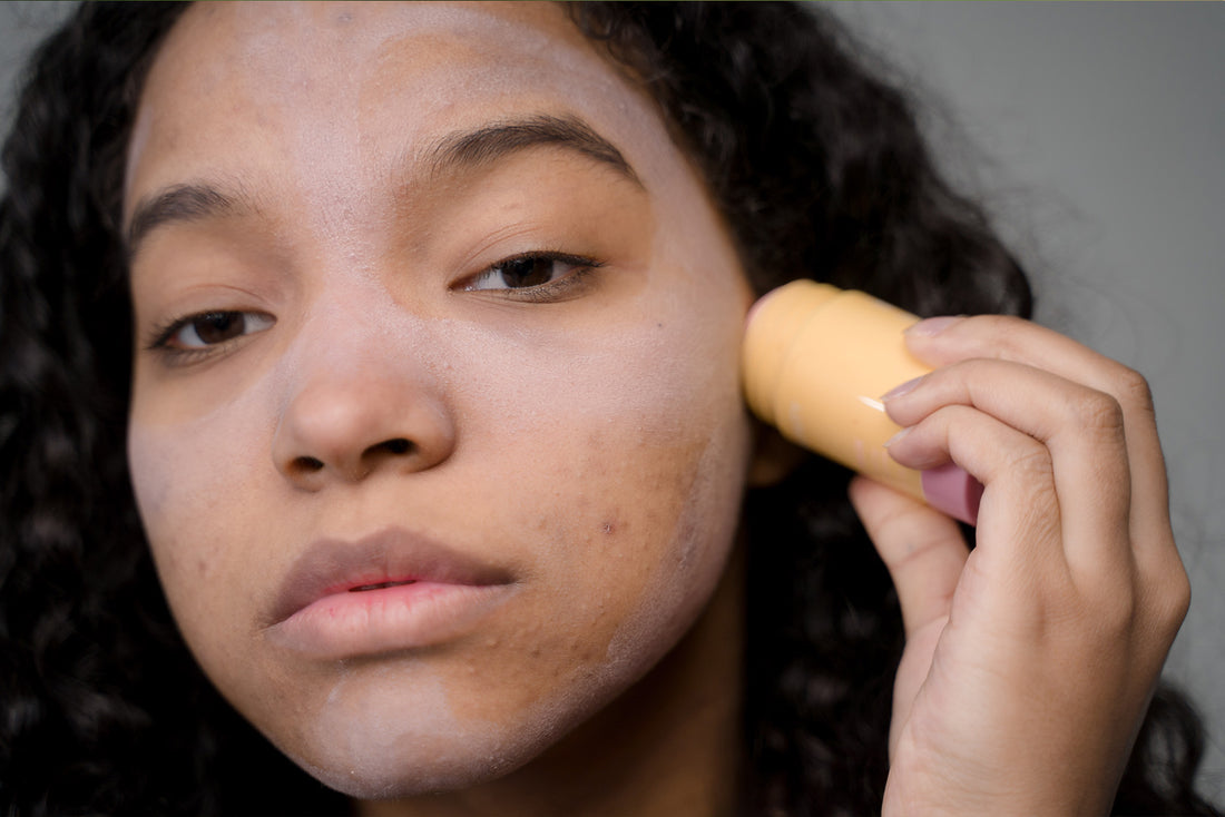 Apple Cider Vinegar for Acne