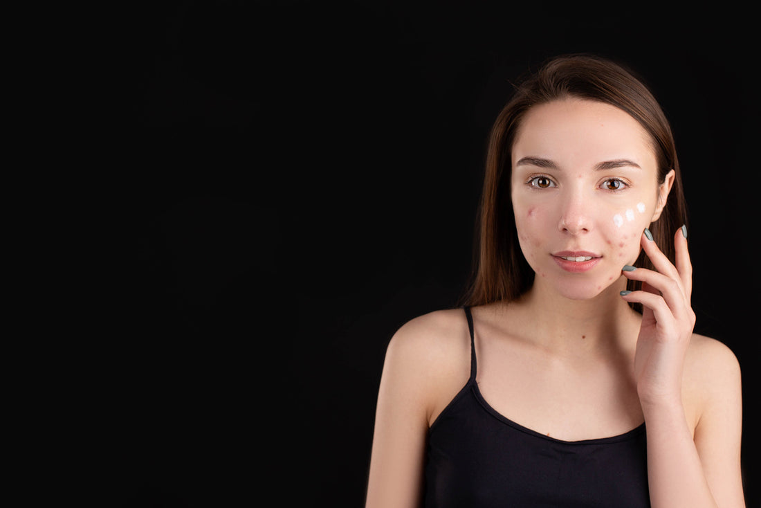 Beta-carotene for Skin and Acne