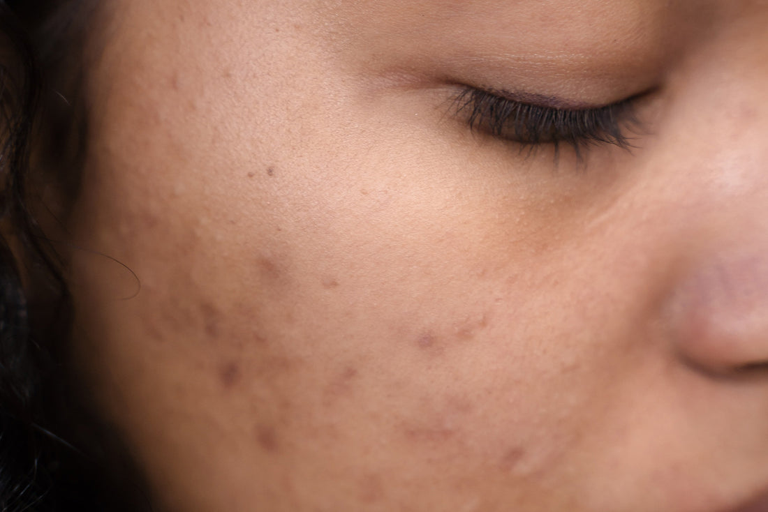 Curcumin for Acne