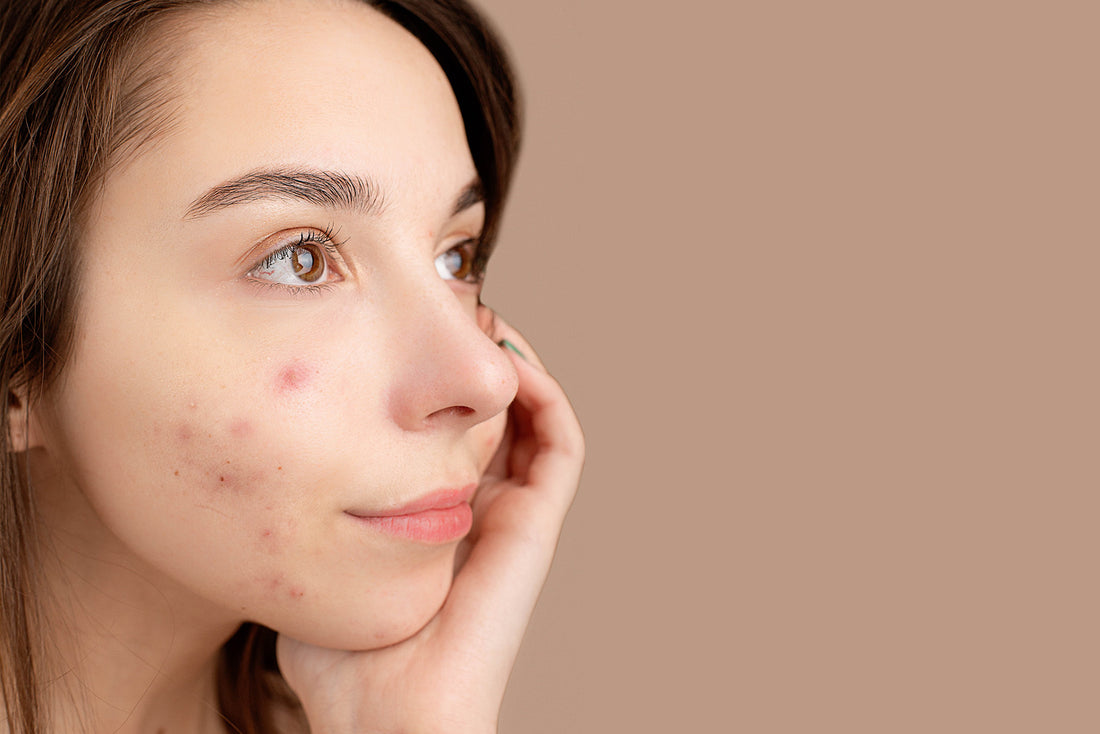 dim for acne