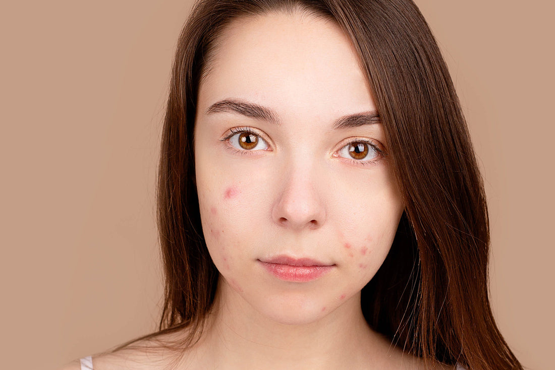 Herbal Remedies for Acne and Blemishes