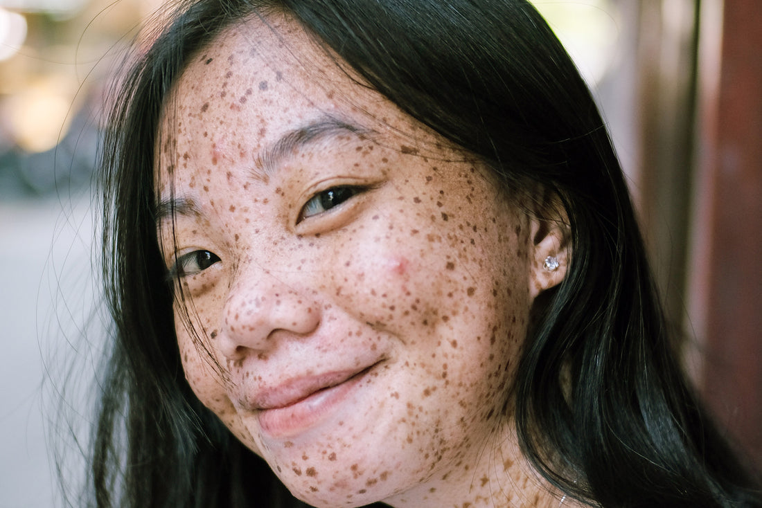 Indole-3-Carbinol for Skin and Acne 