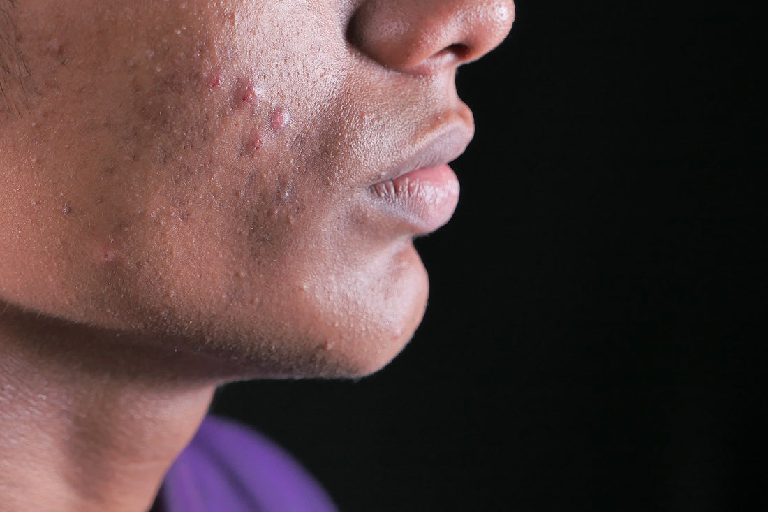 Milk Thistle for Acne