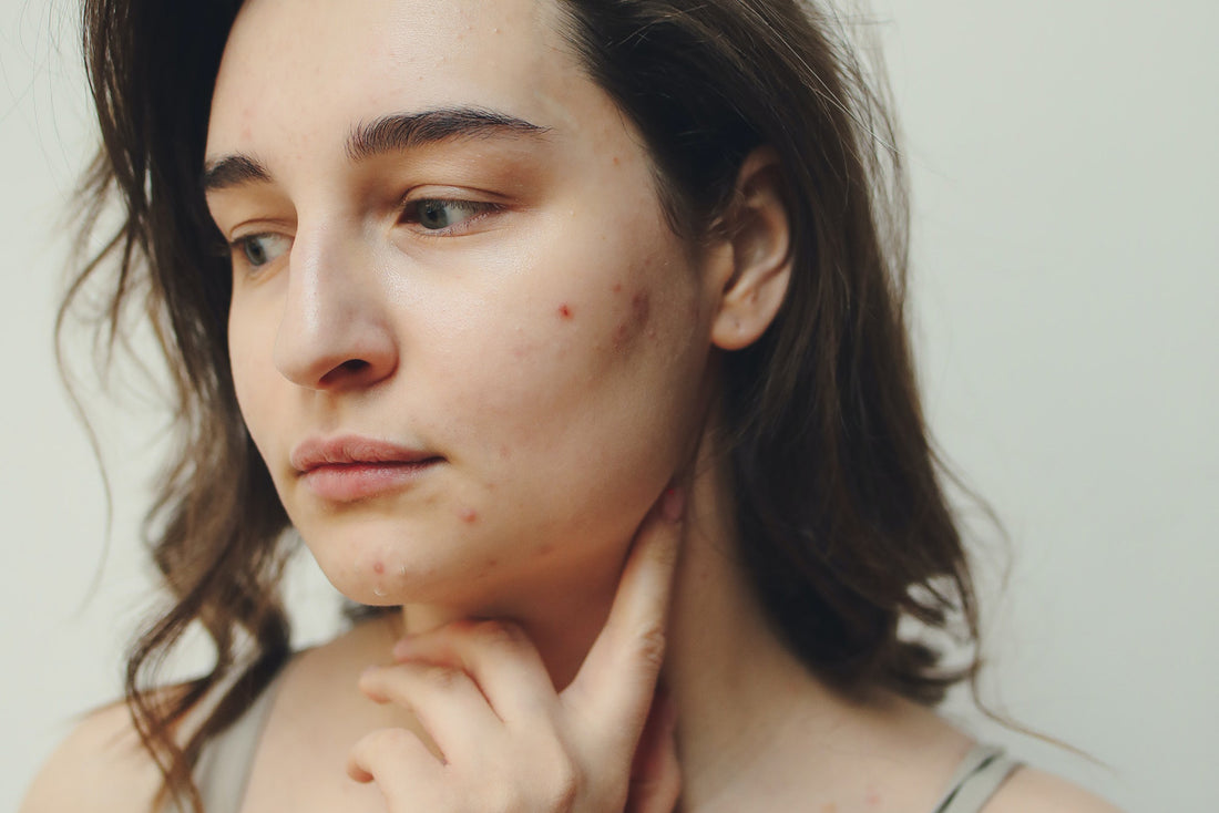 Plant Protein and Acne