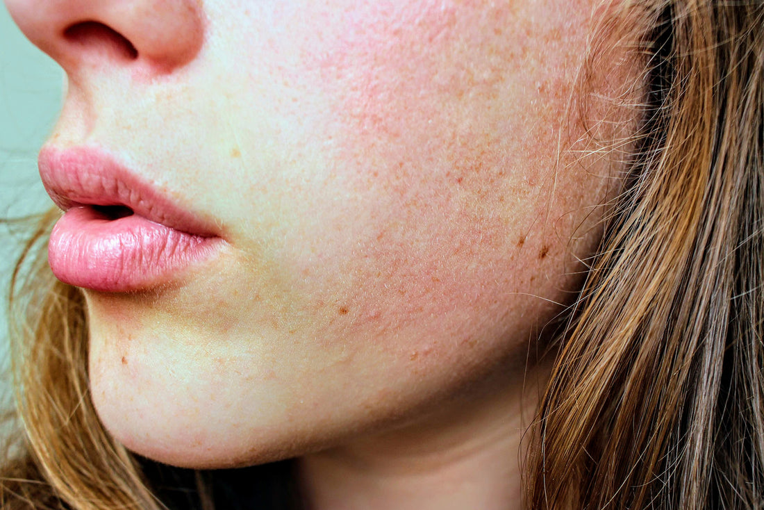 Vitamin C for Hyperpigmentation