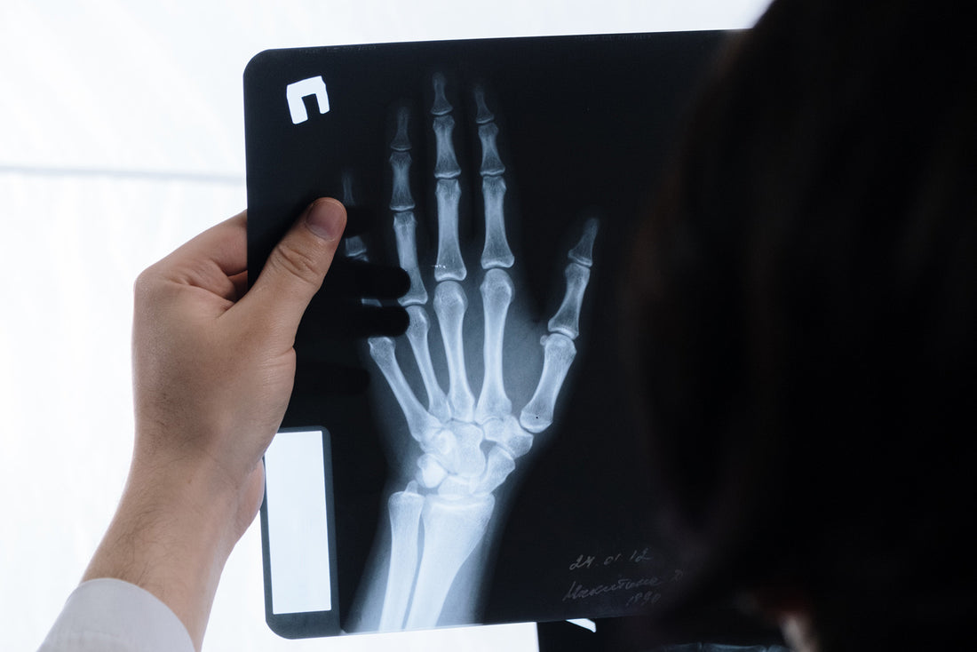 What Supplements are Good for Bones?